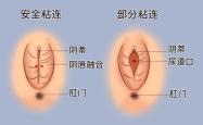 流产后宫腔粘连会有啥症状
