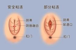 流产后宫腔粘连会有啥症状