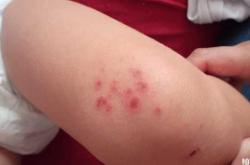 新生儿尿不湿过敏症状图片有哪些