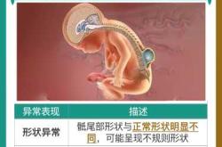 新生儿椎骨发育需注意什么