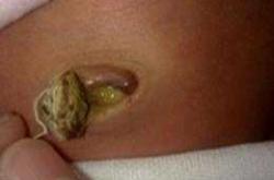 新生儿肚脐眼长啥样