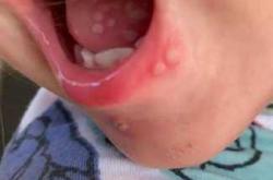 婴儿病毒疹有哪些症状