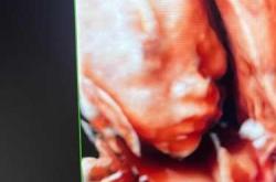 傍晚为何孕反会加重