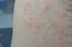 产后腋下长小疙瘩是咋回事