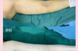 产后多久可以抽脂