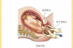 产后阴壁膨出有照片吗
