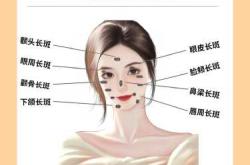 产后脸上长斑的原因是什么