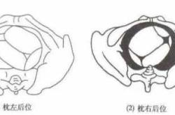枕后位为何不能顺产