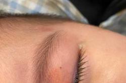 月子里宝宝眼睛有黄眼屎怎么办