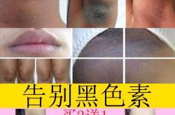产后身体为何变黑