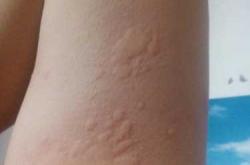 月子里过敏怎么办