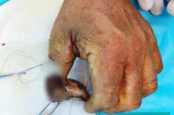 婴儿断指该如何紧急处理