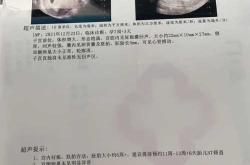 孕50天孕反突然没了正常吗