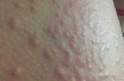 产后刺痒是怎么回事