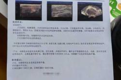 引产后多久能备孕