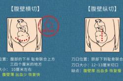 剖腹产刀口长度标准是多少