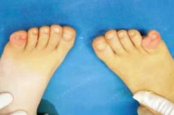 新生儿剪刀脚图片哪里有