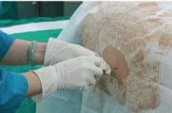 剖腹产有没有打麻药