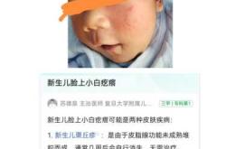 新生儿痤疮是怎么引起的