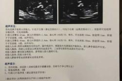 孕12周血糖53有孕反正常吗