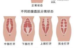 产后腹直肌如何有效恢复训练