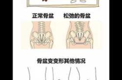 产后多久骨盆就定型了