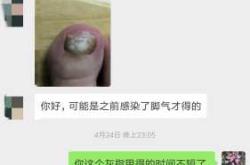 灰指甲和备孕到底有没有关系