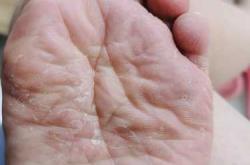 孕6周孕反严重虚脱怎么办