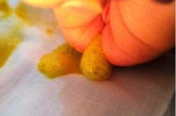 婴儿吃完就拉是怎么回事