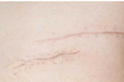 顺产竖切伤口图片是什么样