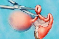 剖腹产三次结扎能复通再生吗