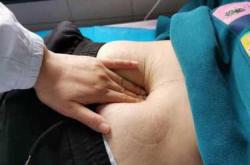 顺产后阴道口如何恢复