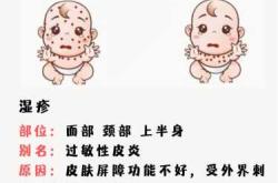 婴儿湿疹和热疹咋区分