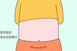 剖腹产横切的利弊有哪些