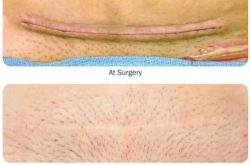 剖腹产有哪些缺陷呢