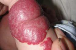 婴儿面部血管瘤该如何治疗