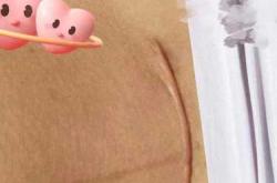剖腹产术后有坠肉咋办