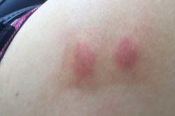 顺产后全身痒是怎么回事