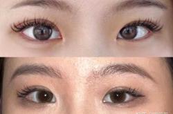 产后眼部会发生哪些变化