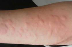 备孕蛋白质过敏有哪些症状