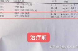 备孕未查甲状腺结节准吗