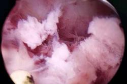 流产后分泌物发黄咋回事