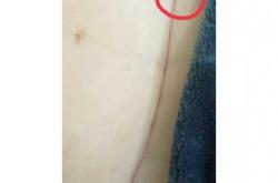 下雨剖腹产伤口会痛吗