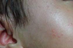 婴儿脸上起痘啥原因怎么办