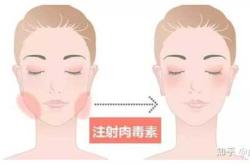 打完瘦脸针多久备孕才有效