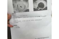 七周孕反不严重正常吗