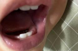 婴儿牙龈发白咋回事