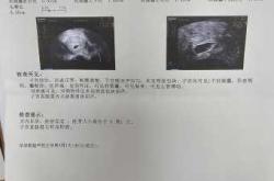 宫外孕手术后多久能怀孕