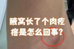 生产后腋窝下有肉疙瘩怎么办