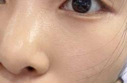 引产后脸长斑如何消